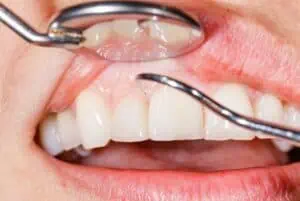 gums being checked by dentist