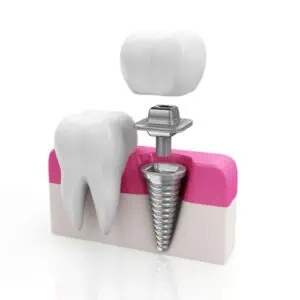 gums being checked by dentist