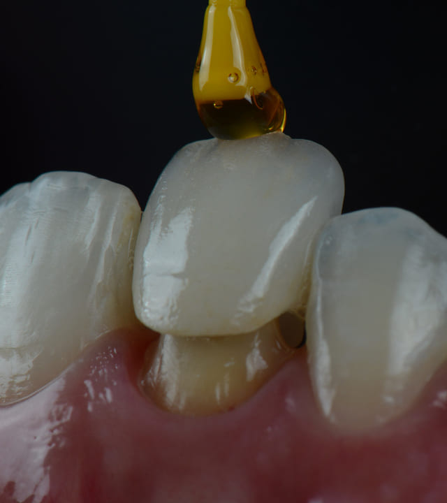 Close up of insertion or placing procedure of a ceramic dental crown in one front teeth.