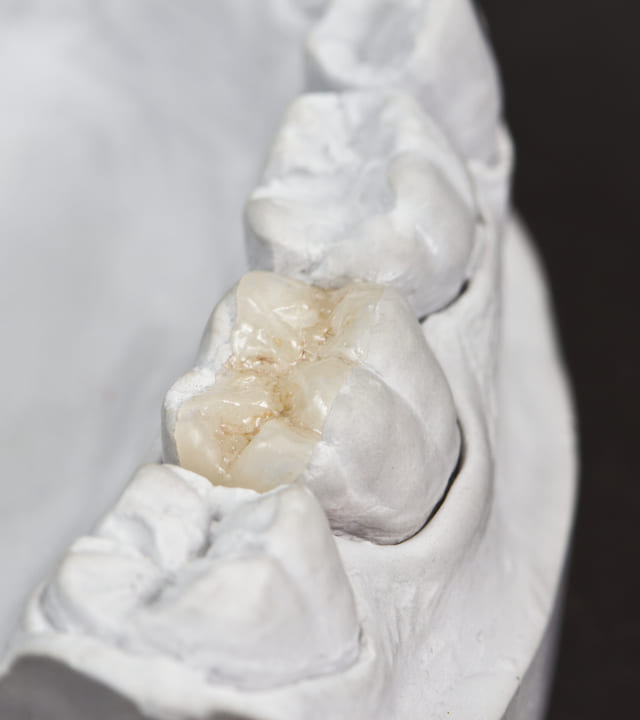 closeup for dental onlay on a molar tooth shown on a plaster model