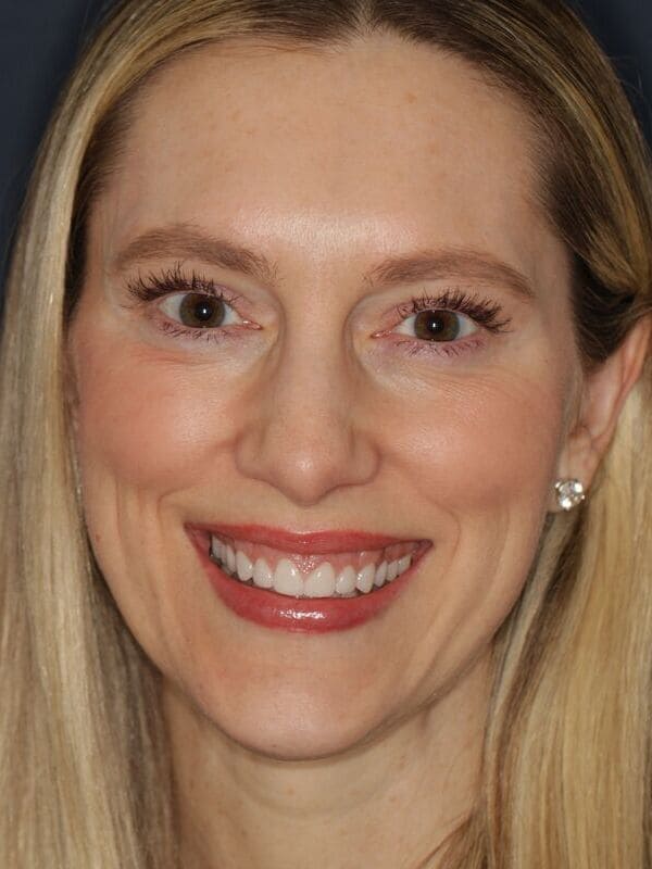 SLim Dental patient smiling after having smile makeover.