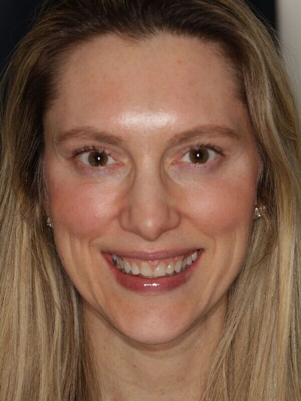 SLim Dental patient smiling before having smile makeover.