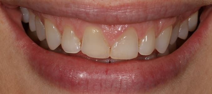 Smile of patient with upper teeth before SLim Dental procedures