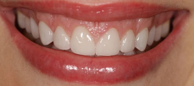 Smile of patient with upper teeth after SLim Dental procedures