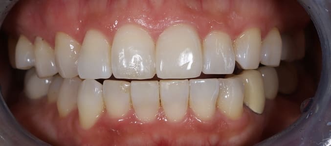 Patient's teeth after restoration, crown matched on upper front tooth.