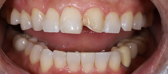 Patient's teeth before restoration, broken upper front tooth