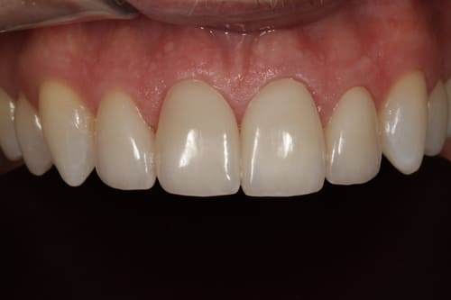 Patient's teeth after restoration, fixed bite and bicycle accident damage
