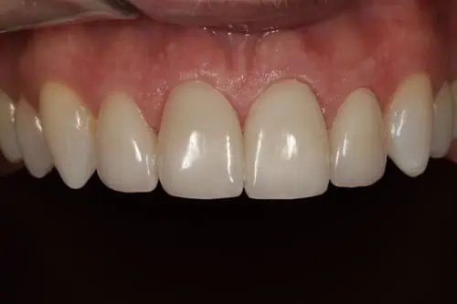 Patient's teeth after restoration, fixed bite and bicycle accident damage