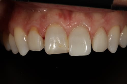 Patient's teeth before restoration,misaligned teeth with wrong bite