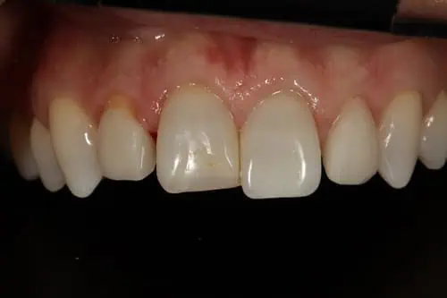 Patient's teeth before restoration,misaligned teeth with wrong bite