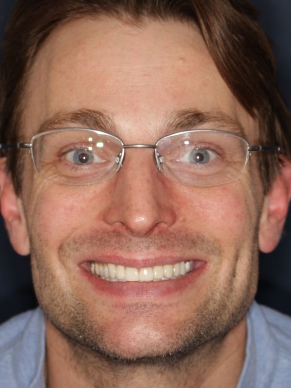 SLim Dental patient smiling after having smile makeover.