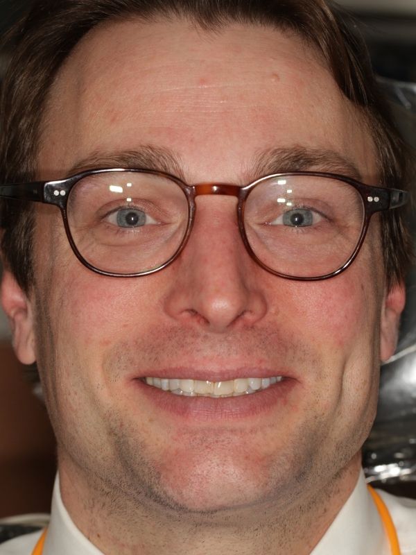 SLim Dental patient smiling before having smile makeover.