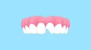 Upper teeth (Chipped) illustration