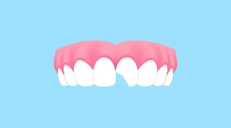 Knocked Out or Chipped a Front Tooth What to Do in the First Hour Upper teeth (Chipped) illustration